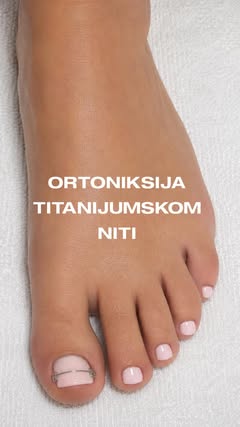 Medicinski pedikir, titanijumska nit za urastao nokat